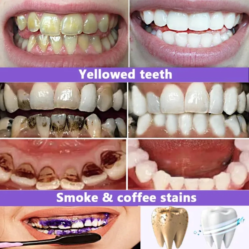 2026 Bestselling Whitening Too - Teeth Whitening Effective 评论和价格