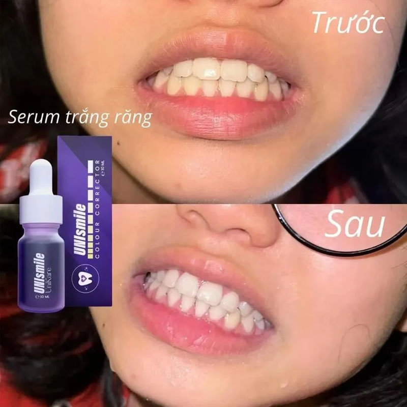Unismile Teeth Whitening Essen - Teeth Whitening Effective 评论和价格