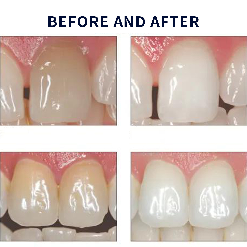 Opalescence Whitening 20% PF 2 - Teeth Whitening With Peroxide 评论和价格