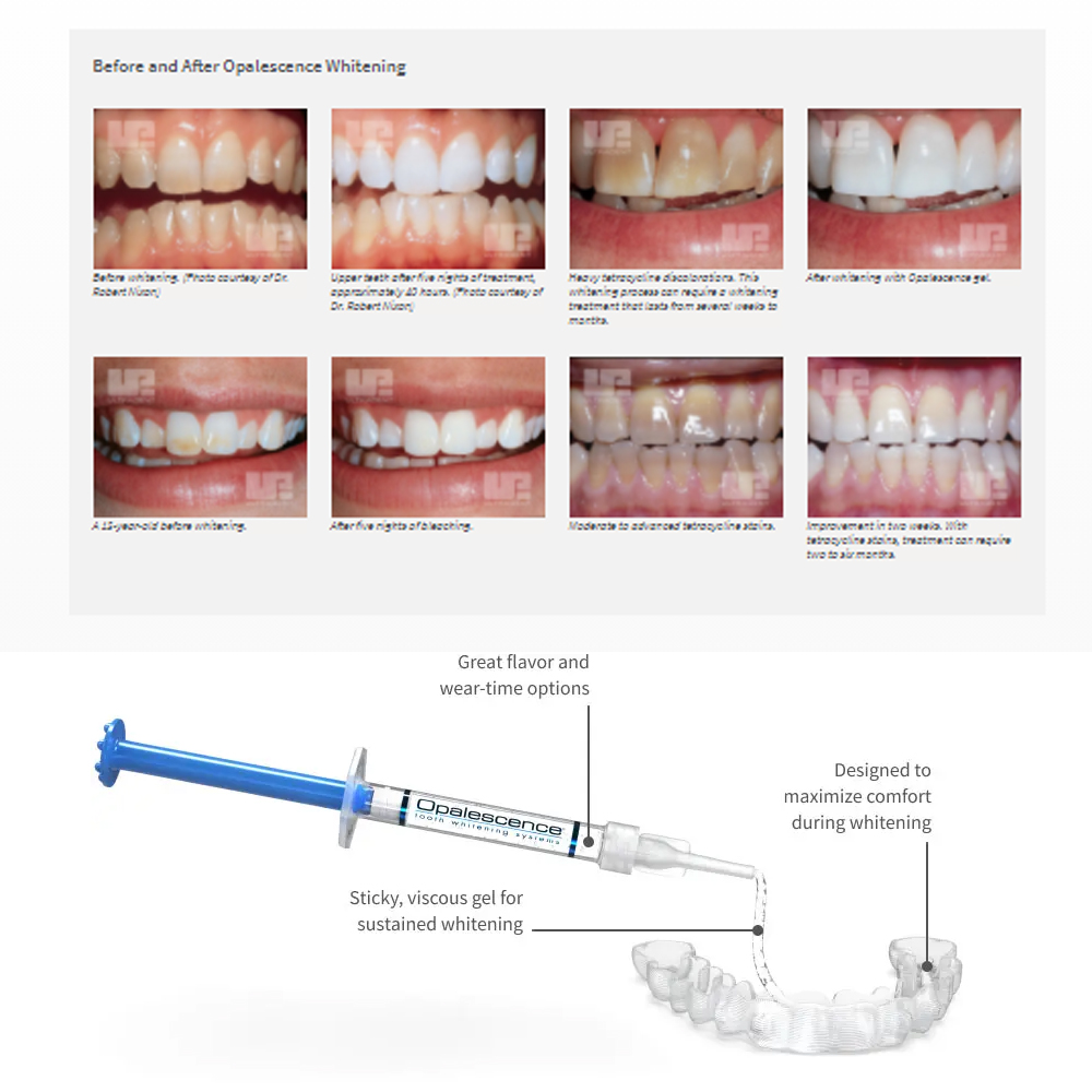 Opalescence Whitening 20% PF 2 - Teeth Whitening With Peroxide 评论和价格
