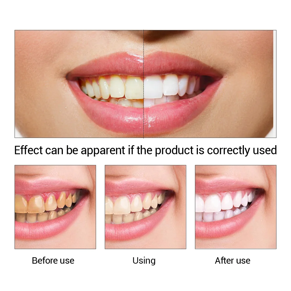 FTEENPLY Teeth Whitening Essen - Teeth Whitening Results 评论和价格