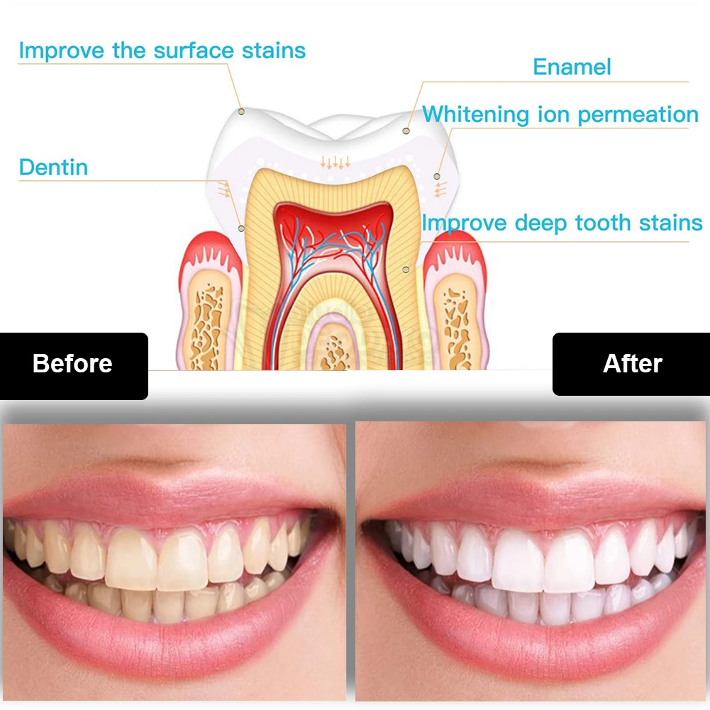 Dental Teeth Whitening Kit Min - Teeth Whitening Kit With Light 评论和价格